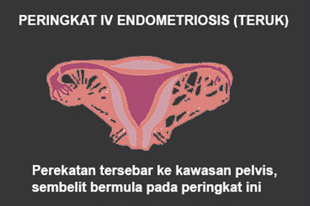 Endometriosis Information Myendosis